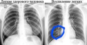 Пневмония на рентгене