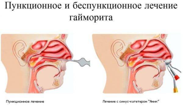 Последствия прокола гайморовых пазух - как избежать осложнений