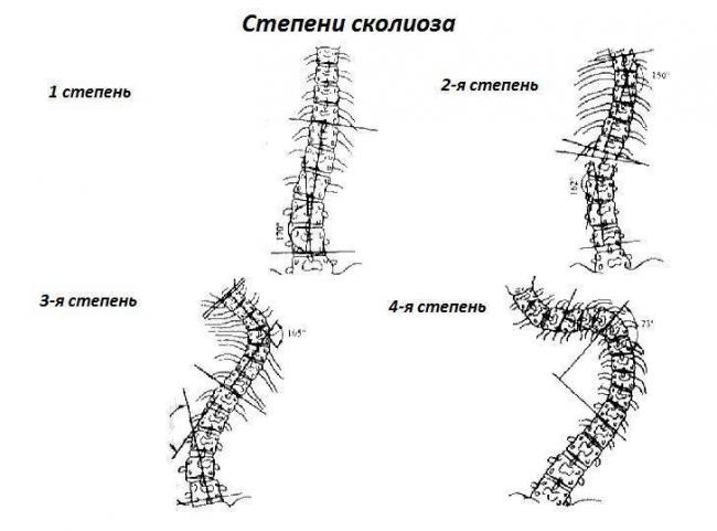 Сколиоз: диагностика, лечение, профилактика
