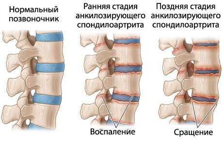 Анкилозирующий спондилит (болезнь бехтерева)