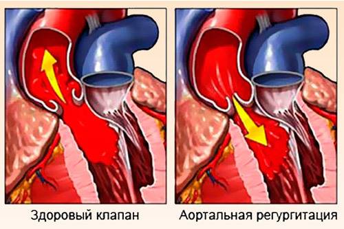 Физиологическая регургитация трикуспидального клапана