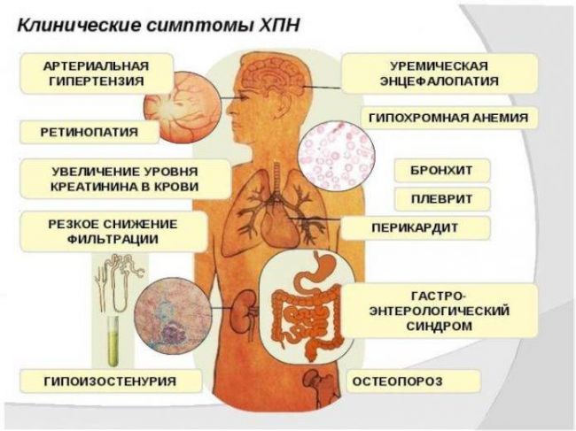 Что такое нефросклероз почек, как лечить