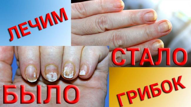Формы ногтей при различных заболеваниях. изменения размера и внешнего вида. фото