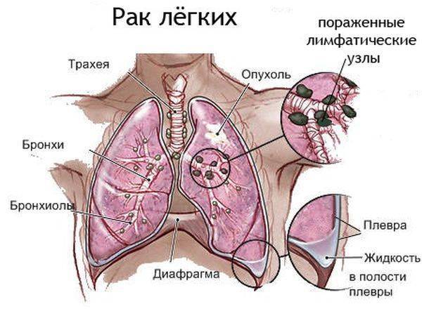 При кашле болит левый и правый бок под ребрами одновременно