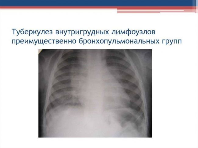 Туберкулёз лимфоузлов: симптомы, лечение, заразен или нет, диагностика