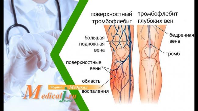 Флебит вены на руке лечение после катетера