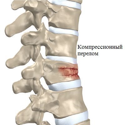 Реабилитация после перелома позвоночника: методы и продолжительность