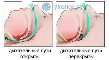 Как лечить храп у мужчин: самые эффективные способы