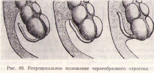 Аппендицит. причины, симптомы, диагностика и лечение.