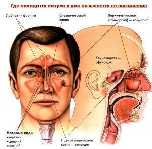 Как вылечить вазомоторный ринит народными средствами, препаратами