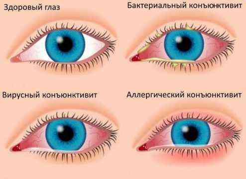Гноятся глаза у взрослого чем лечить народными средствами