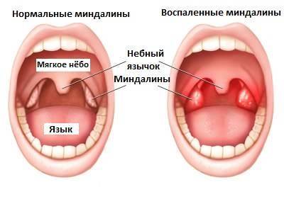 Чем и как полоскать горло? рецепты при ангине, боли в горле