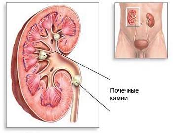 Камни в почках — угроза организму в целом