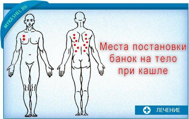 Банки на позвоночник: противопоказания