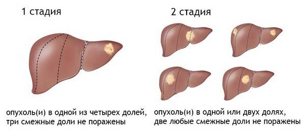 Гемангиома печени диета