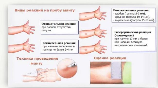 Через сколько дней проверят манту, реакция манту по дням