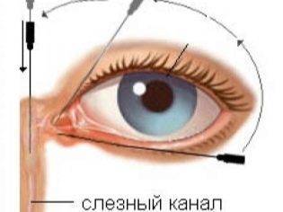 Как мы вылечили непроходимость слезного канала (дакриоцистит) без зондирования
