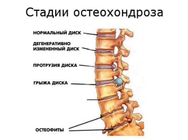 Какие народные средства применяют для лечения остеохондроза шейного отдела позвоночника?