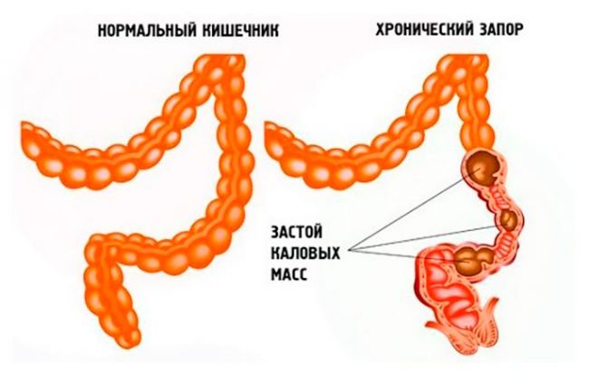 Мягкое слабительное для очищения кишечника быстрого действия