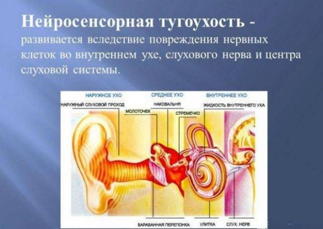 Нейросенсорная тугоухость: симптомы и лечение 1-4 степеней у взрослых и детей