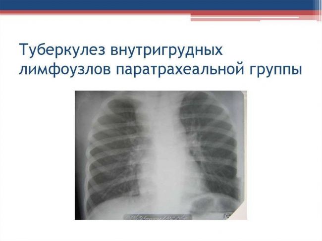 Туберкулез внутригрудных лимфатических узлов (бронхоадениты)