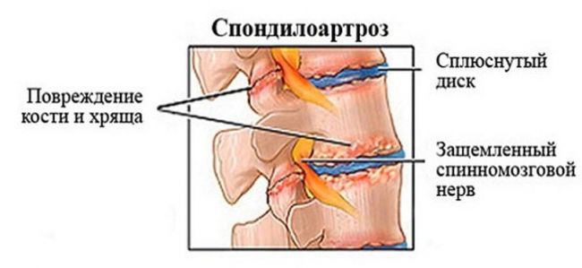 Болит левый бок со спины в пояснице, причины боли слева при движении