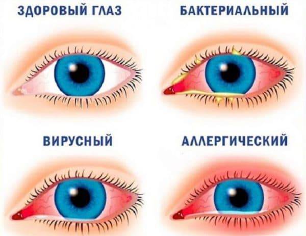 Резь в глазах: причины и лечение, капли, народные средства, сопутствующие симптомы (сухость, ощущение песка, будто что-то попало, слезоточивость, боль, покраснение, жжение)