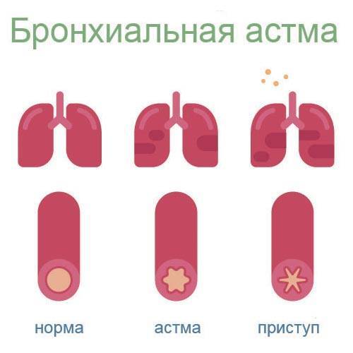 Механизм развития, симптомы и лечение бронхиальной астмы физического усилия