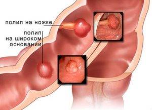 Полипы в носу лечение без операции