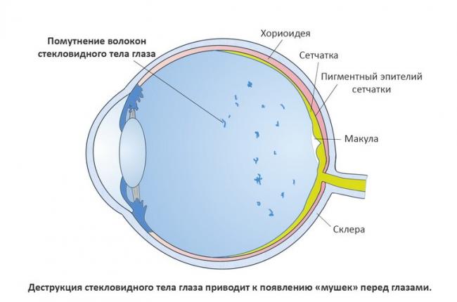 Как проявляется деструкция стекловидного тела