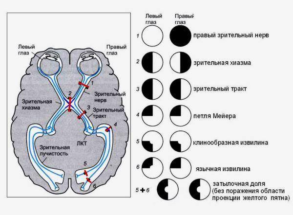 Лечение гемианопсии после инсульта