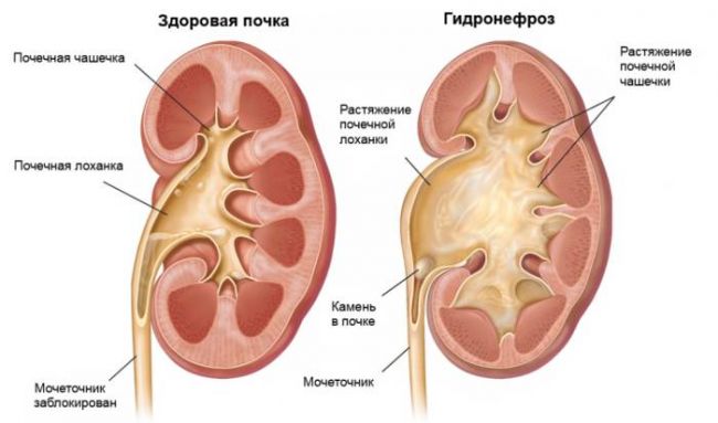 Диета при заболевании почек: меню стола номер 7 при больных почках