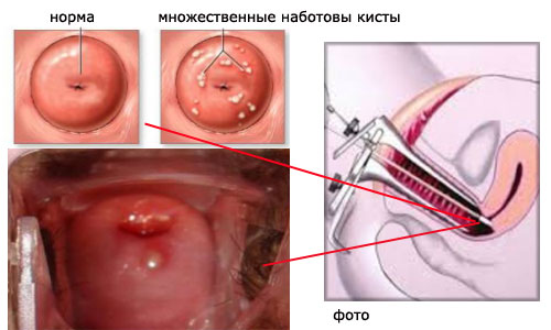 Чем опасны кисты в области шейки матки и как бороться с ними