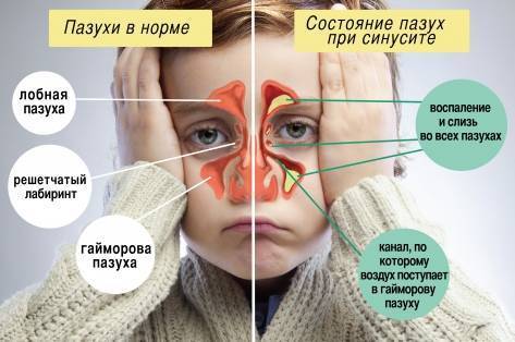Как вылечить гайморит без прокола современными малоинвазивными методами
