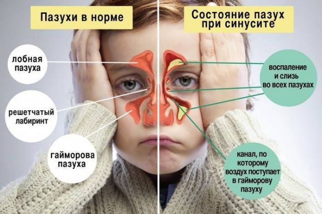 Антибиотик при гайморите взрослым название препаратов