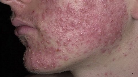 Себорея кожи головы у детей лечение