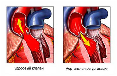 Что представляет из себя митральная регургитация 1 степени и трикуспидальная регургитация