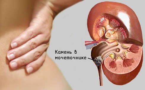 Камни в почках: симптомы, причины образования, диагностика, лечение