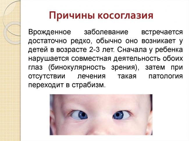 Причины и лечение расходящегося косоглазия