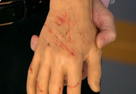 Болезнь кошачьих царапин