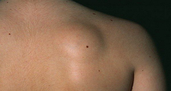 Классификация первичных злокачественных неэпителиальных опухолей легких