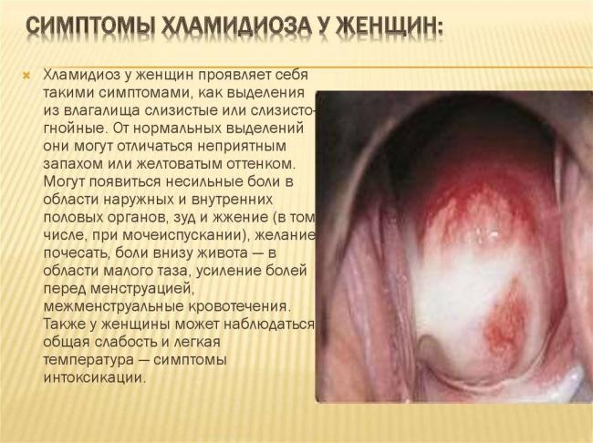 Симптомы хламидиоза у женщин — лечение, схемы, осложнения