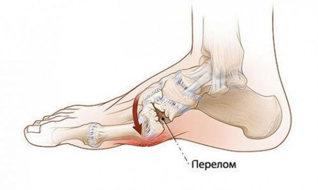 Диета при переломах