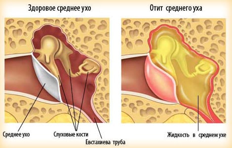 Острый отит