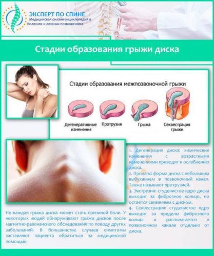 Упражнения бубновского при грыже грудного и шейного отдела позвоночника