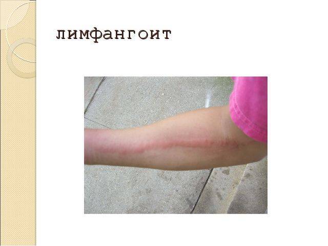 Правильная постановка пробы манту: алгоритм действий