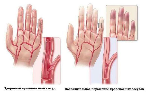 Облитерирующий тромбангиит: симптомы, диагностика и лечение болезни бюргера