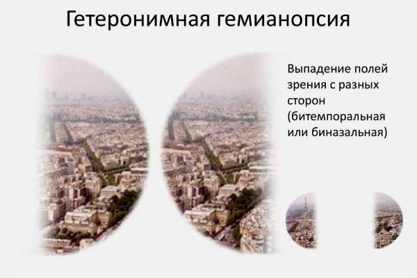 Лечение гемианопсии после инсульта