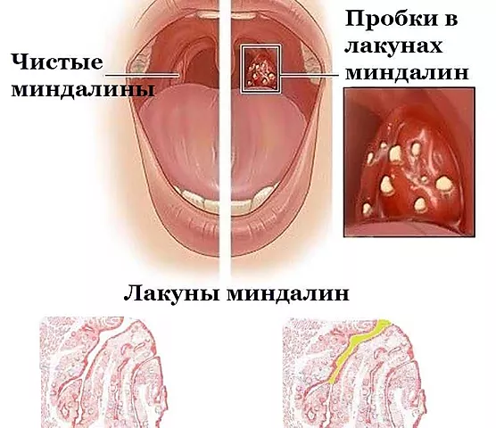 Методы эффективного лечения пробок и налета на миндалинах