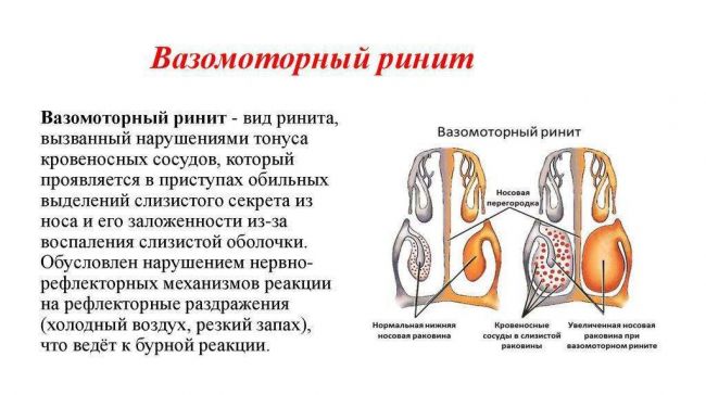 Как вылечить вазомоторный ринит народными средствами, препаратами